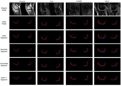 Automated measurement and grading of knee cartilage thickness: a deep learning-based approach